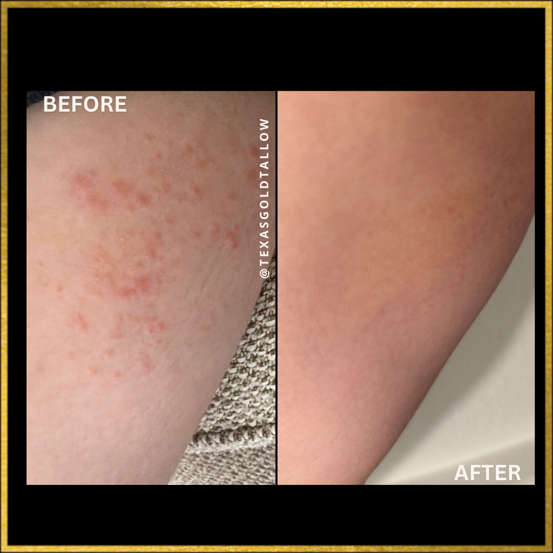 Before and after results after using Texas Gold Tallow instant relief 